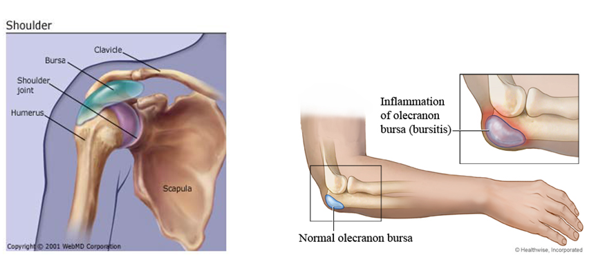 What You Need to Know About Bursitis ~ THE DOCTOR IS IN!