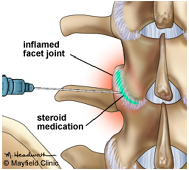 Facet Joint Disease ~ THE DOCTOR IS IN