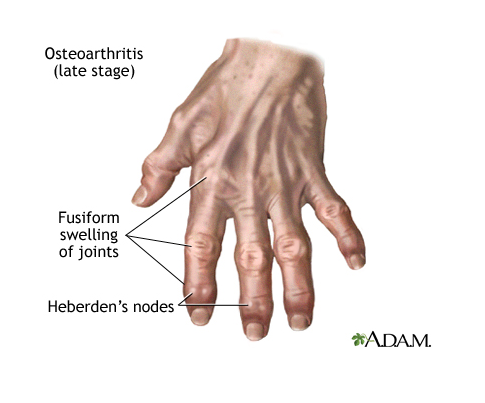 Rheumatoid Arthritis vs. Osteoarthritis ~ THE DOCTOR IS IN